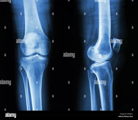 Normal Knee X Ray Hi Res Stock Photography And Images Alamy