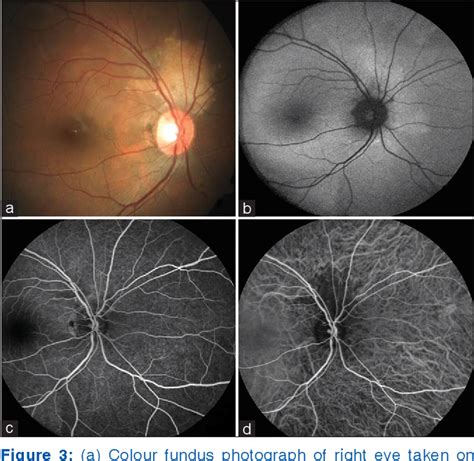 Figure 3 From Recurrent Posterior Scleritis With Secondary Choroidal