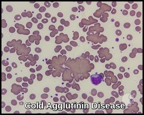 Cold Agglutinin Disease Ask Hematologist Understand Hematology