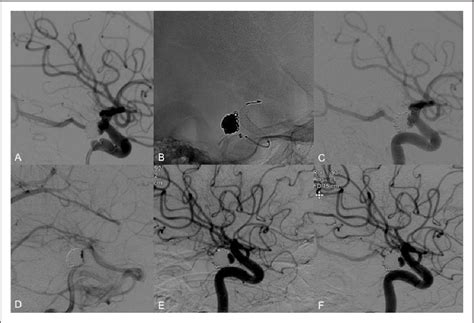 Figure From Flow Diverter Stents For Endovascular Management Of Non