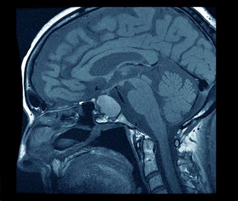 Brain Tumour By Zephyr Science Photo Library