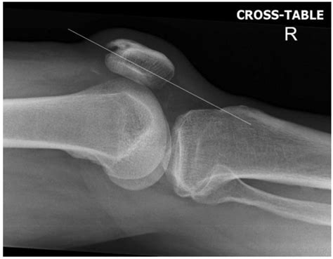 Patella Fracture - Trauma - Orthobullets