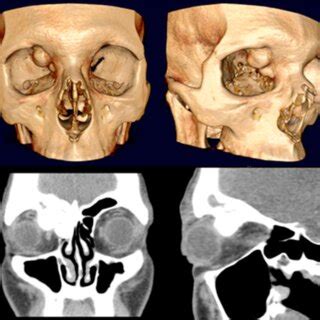 D Ct Images Showing The Right Fronto Ethmoidal Osteoma With Orbital