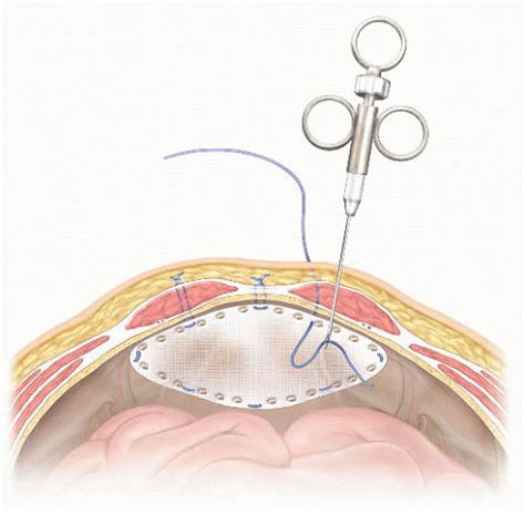 Incisional Hernia Laparoscopic Approaches Basicmedical Key