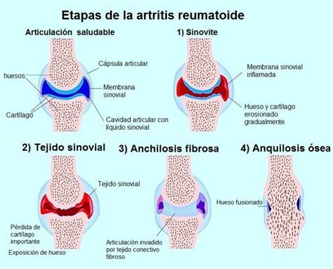 Artritis reumatoide descubre aquí todos los síntomas de esta enfermedad