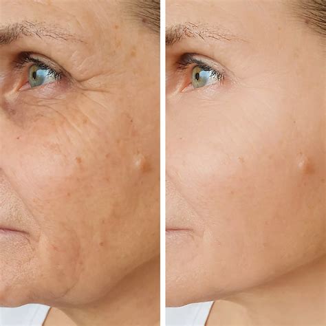 Sculptra Aesthetic Injectable Fillers In Santa Rosa And Healdsburg