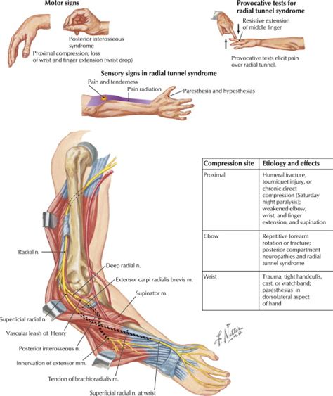 Diagnosis and Treatment of Work-Related Proximal Median and Radial Nerve Entrapment ...