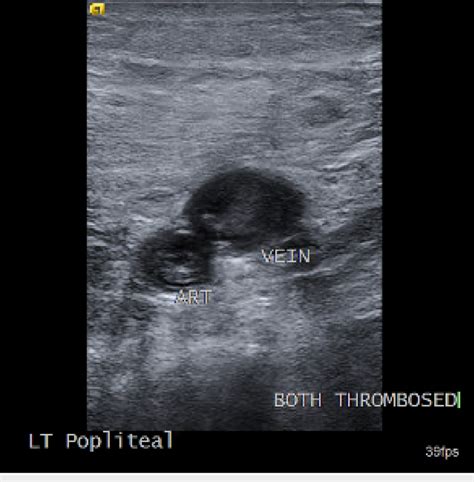 Left popliteal artery and vein, visualized in the axial view of ...