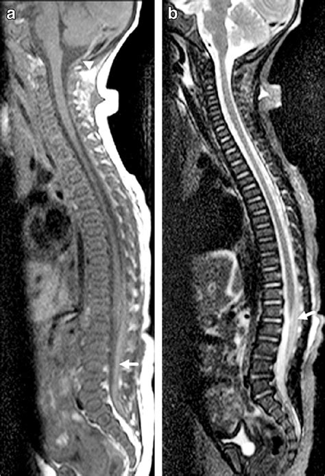 Abusive Head Trauma In A Month Old Boy A Sagittal T W Mri Of The