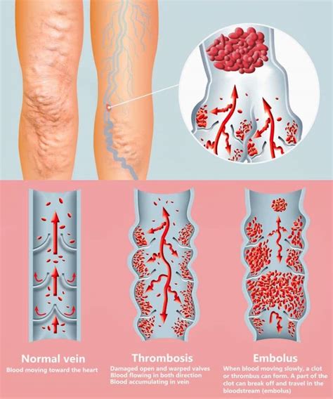 ¿qué Es La Flebitis Tipos Y Tratamiento