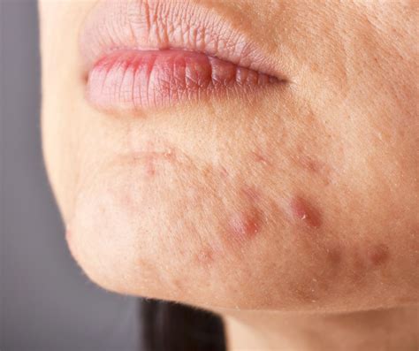 Hormonal Acne Causes Symptoms And Targeted Treatments Freyja Medical