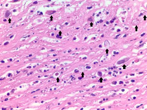 Pathology Outlines Acanthamoeba Keratitis