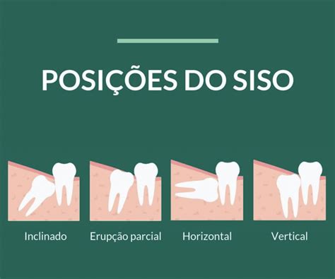 Extra O Dos Sisos Coisas Que Voc Precisa Saber Studiouno Odontologia