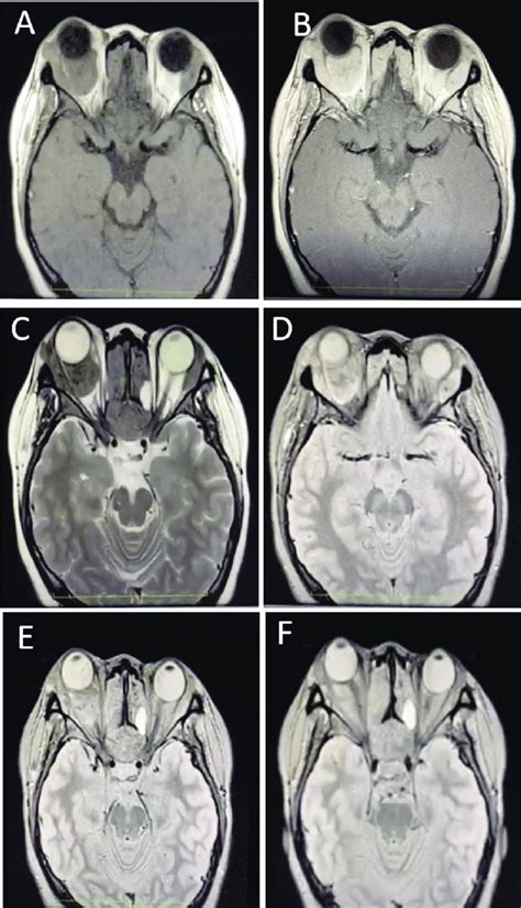 MRI Of The Orbits A T1 Weighted Axial Plain Sequence Showing The