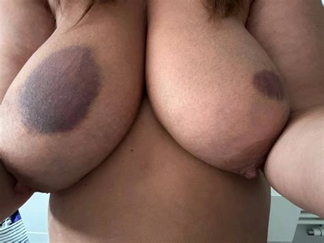 Meine Titten Zwei Tage Nach Dem Ficken 1 Nude Pics XHamster