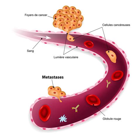 M Tastase D Finition Sympt Mes Pronostic D Un Cancer M Tastatique