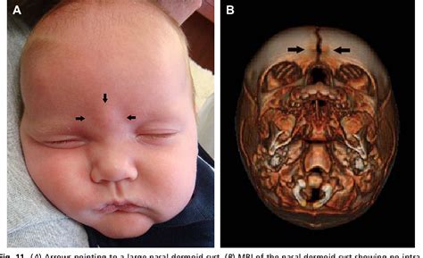 Dermoid Cyst Forehead