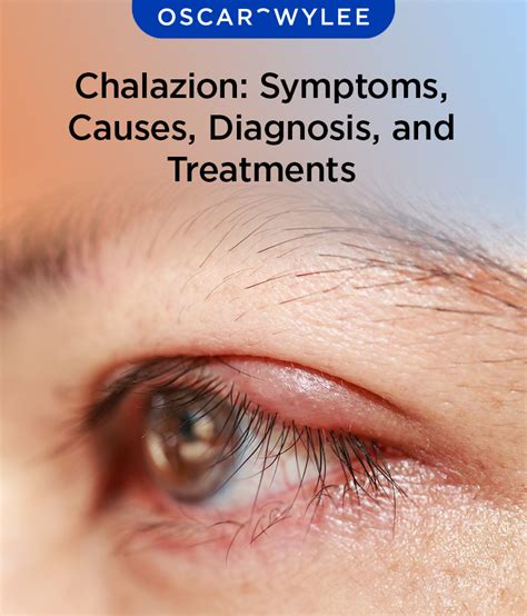 Chalazion Symptoms Causes Diagnosis And Treatments Nbkomputer