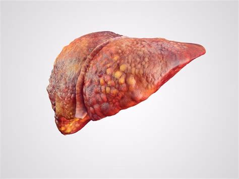 Liver Disease / Hepatic Disease - From the initial symptoms to liver ...