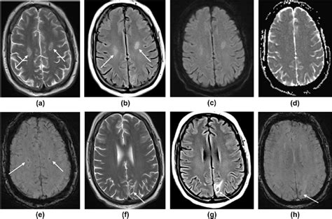 MRI images showing symmetrical white matter signal change. (a) T2W, (b ...