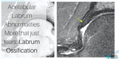 Hip Labrum Ossification Mri Labral Abnormalities More Than Just Tears