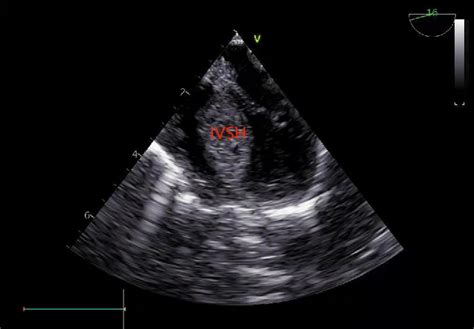 Figure 1 from The Interventricular Septal Hematoma Following Surgical ...