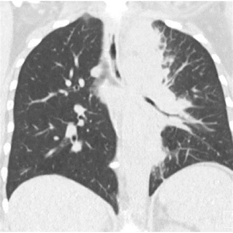 The pathology slide of the subcarinal lymph node (100x) demonstrating... | Download Scientific ...