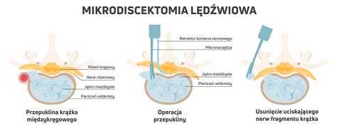 Jakie S Rodzaje Operacji Kr Gos Upa Szpital Ywiec