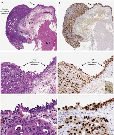 Flat Pattern Of Nephrogenic Adenoma Previously Unrecognized Pattern Unveiled Using Pax2 And