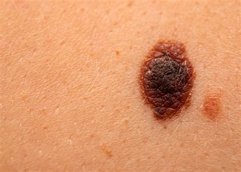 Melanoma Teguhdita