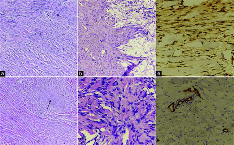 Images Showing A A Spindle Cells Tumor With Bland Nuclei Arranged In