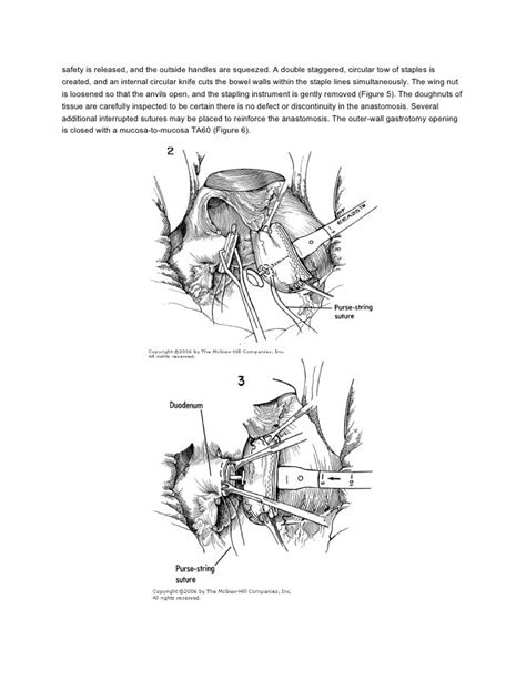 Hemigastrectomy Billroth I Stapled