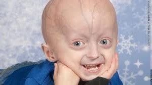 Adeal News: Progeria Facts as rare Genetic Condition | Lite Review