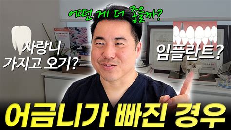 어금니가 빠진 경우 교정으로 사랑니 가지고오기 Vs 임플란트 Youtube