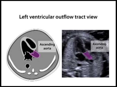 Left Ventricular Outflow Tract View Ultrasound Diagnostic