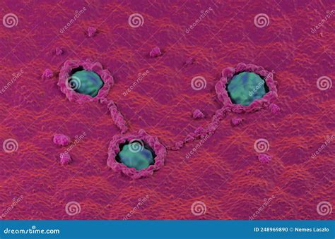 Cancerous Colon Surface Super Macro Colorectal Cancer Isometric View 3d Illustration Stock