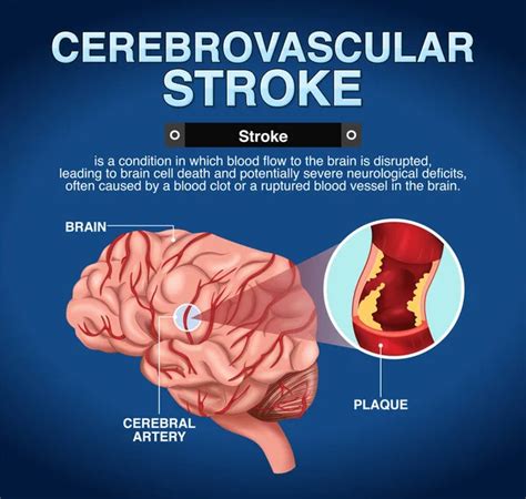 Human Hemorrhagic Stroke Illustration Stock Vector By ©blueringmedia 576530158