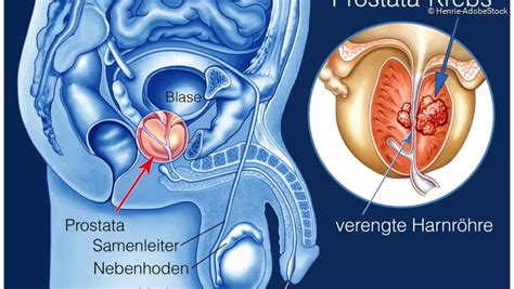 Benigne Prostatahyperplasie Symptome NetDoktor De