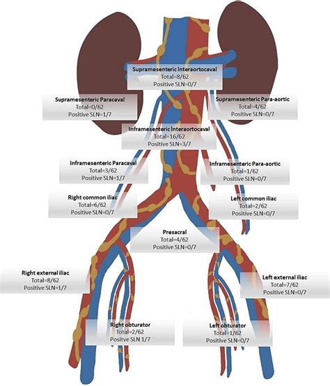 Mapping Sentinel Lymph Nodes In Early Stage Ovarian Cancer Melisa