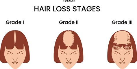 Skala Tahapan Kebotakan Wanita Female Pattern Baldness Roegan