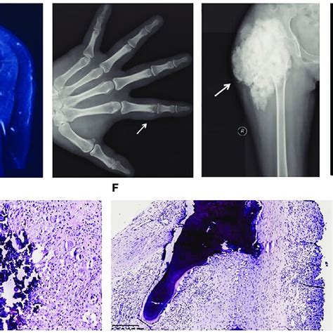 Image Findings And Pathological Features Of Hyperphosphatemic Familial