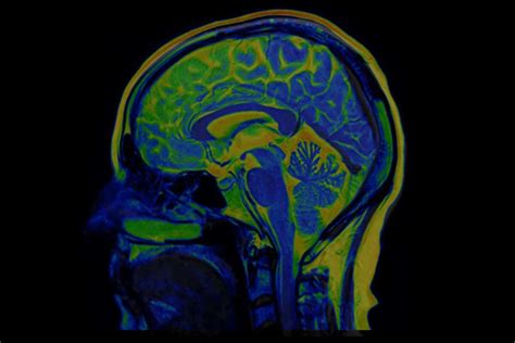 A study reported details of neurological injury in COVID-19 patients