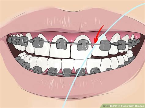 4 Ways to Floss With Braces - wikiHow