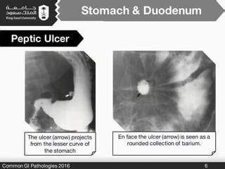 Common Gi Pathologies Ppt