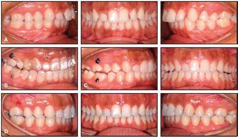 Creative Adjuncts For Clear Aligners Part 1 Class Ii Treatment Jco Online Journal Of