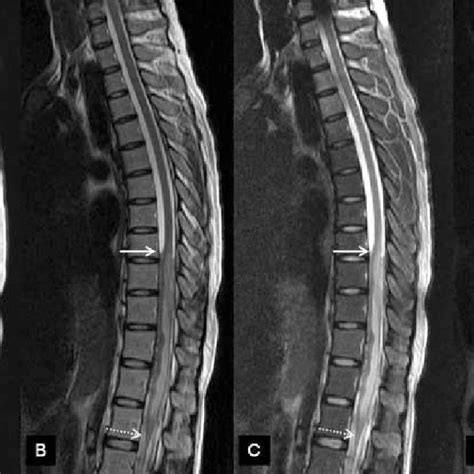 MRI of the spine depicts replacement of the subarachnoid space with a... | Download Scientific ...