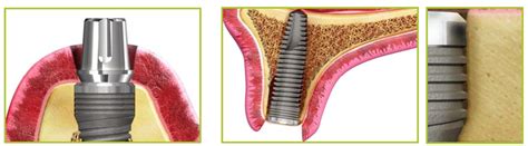 Neodent Alvim II Plus Implante Dental SpotImplant