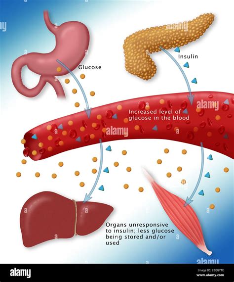 Diabetes Mellitus Tipo Fotos Und Bildmaterial In Hoher Aufl Sung