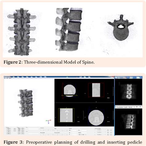 Pdf Preoperative Planning And Simulation For Pedicle Screw Insertion