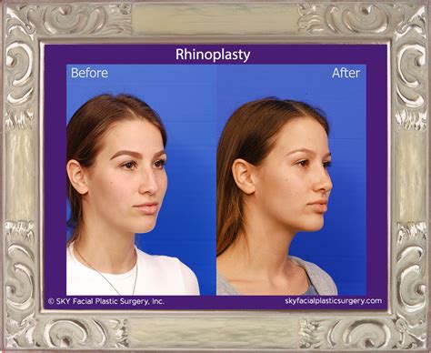 San Diego Rhinoplasty Specialist — Sky Facial Plastic Surgery